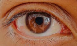 Göz tansiyonunda erken teşhis kalıcı körlüğün önüne geçiyor