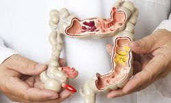 Kolon Kanseri Bu Yöntemle Önlenebiliyor!