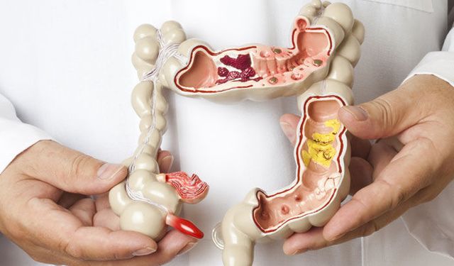 Kolon Kanseri Bu Yöntemle Önlenebiliyor!